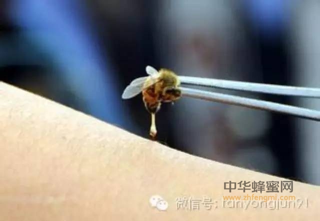 瘫痪女子被蜜蜂蜇1500次重新站立 ！