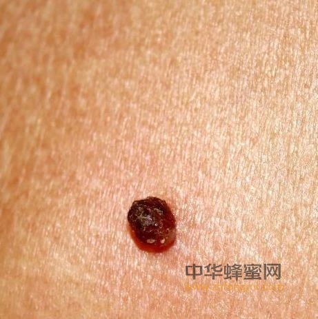 皮肤有3个“现象”，别以为是皮炎，可能是“肿瘤”想靠近你！